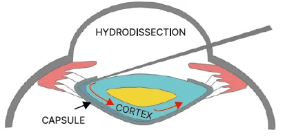 Hydrodissection