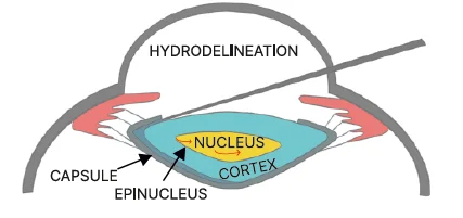 Hydrodelineation
