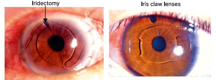 iridectomy