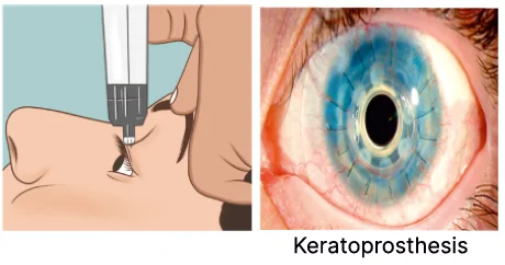 transpalpebral tonometer