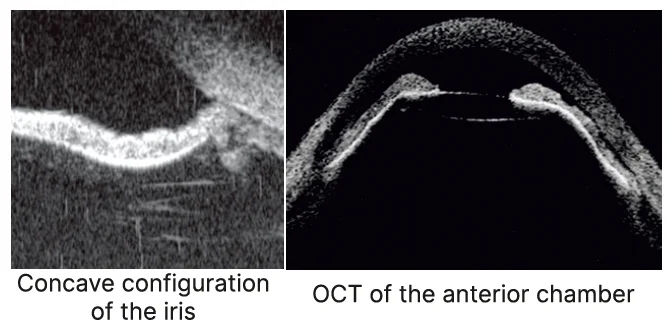 ultrasound biomicroscopy