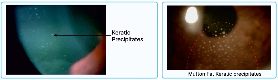 Anterior-Uveitis