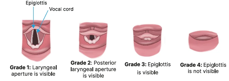Cormack-Lehane Grading
