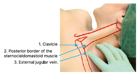 Supraclavicular route