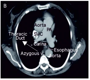 key mediastinal structures