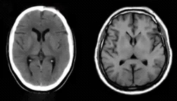 CT vs MRI scan