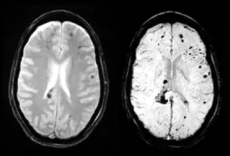 SWI ( Susceptibility Weighted Imaging)