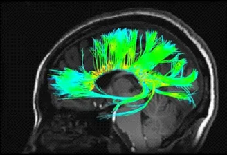 MR Tractography DTI