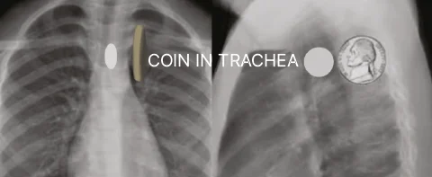 Coin in Trachea 