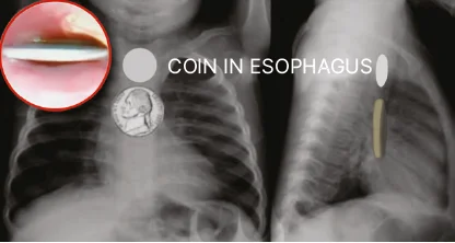 Coin in Esophagus