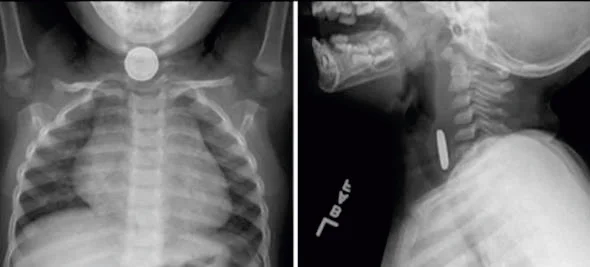 button battery on an X-ray