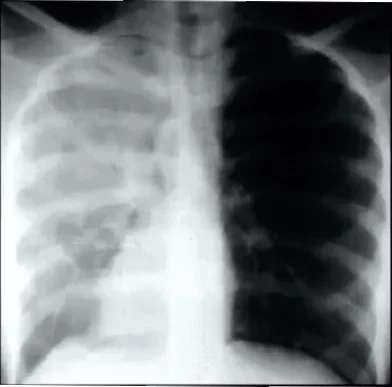 No tracheal shift