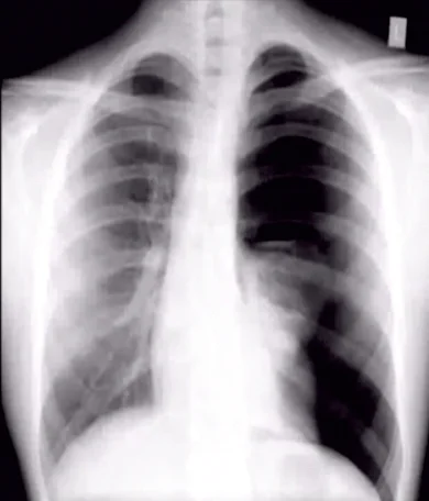 Pneumothorax Emphysema