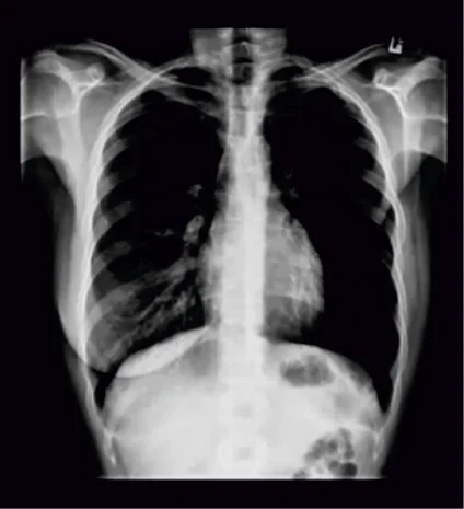 Post mastectomy Poland syndrome
