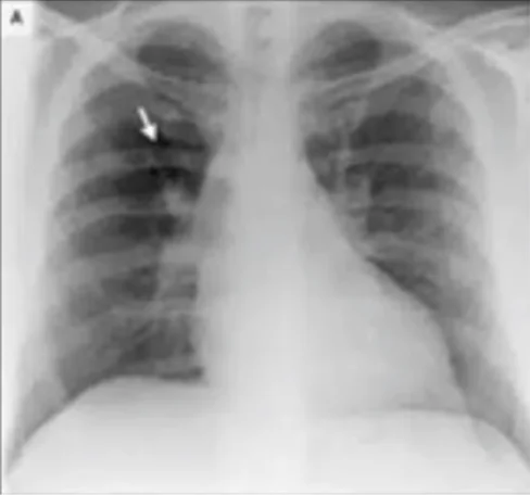 Pulmonary embolism (Westermark sign)