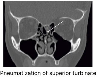 Concha bullosa (Pneumatization of middle turbinate)