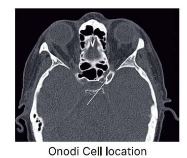 Onodi cell