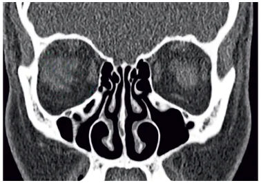 Haller cell Infraorbital air cell