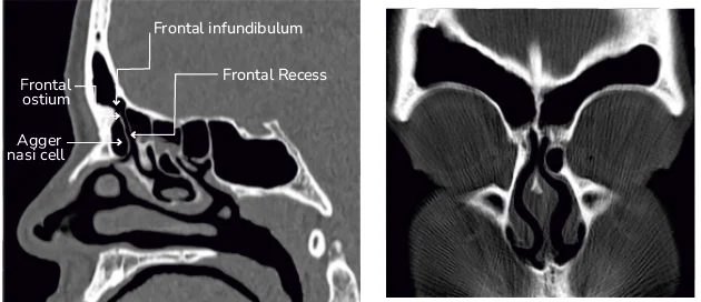 Agger nasi Anterior-most ethmoidal cell