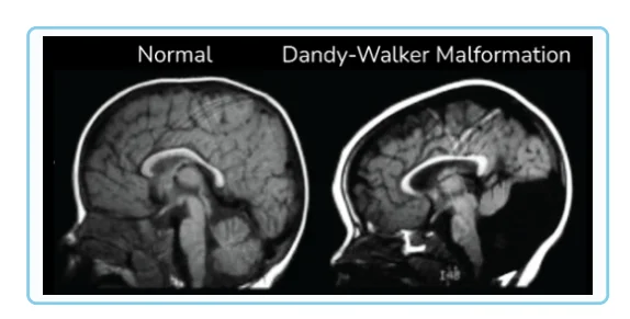 Dandy-Walker syndrome