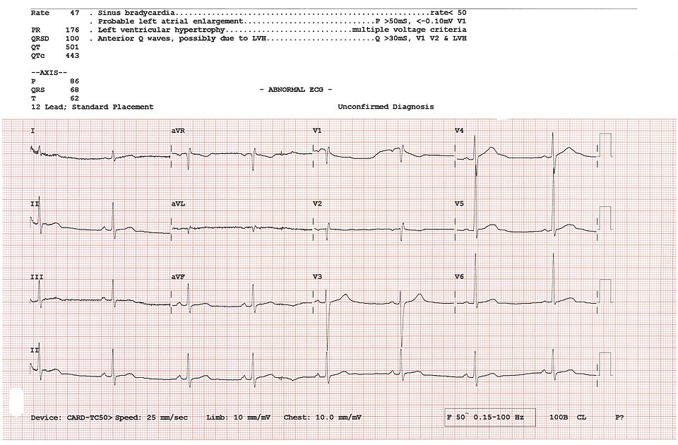 12-lead ECG