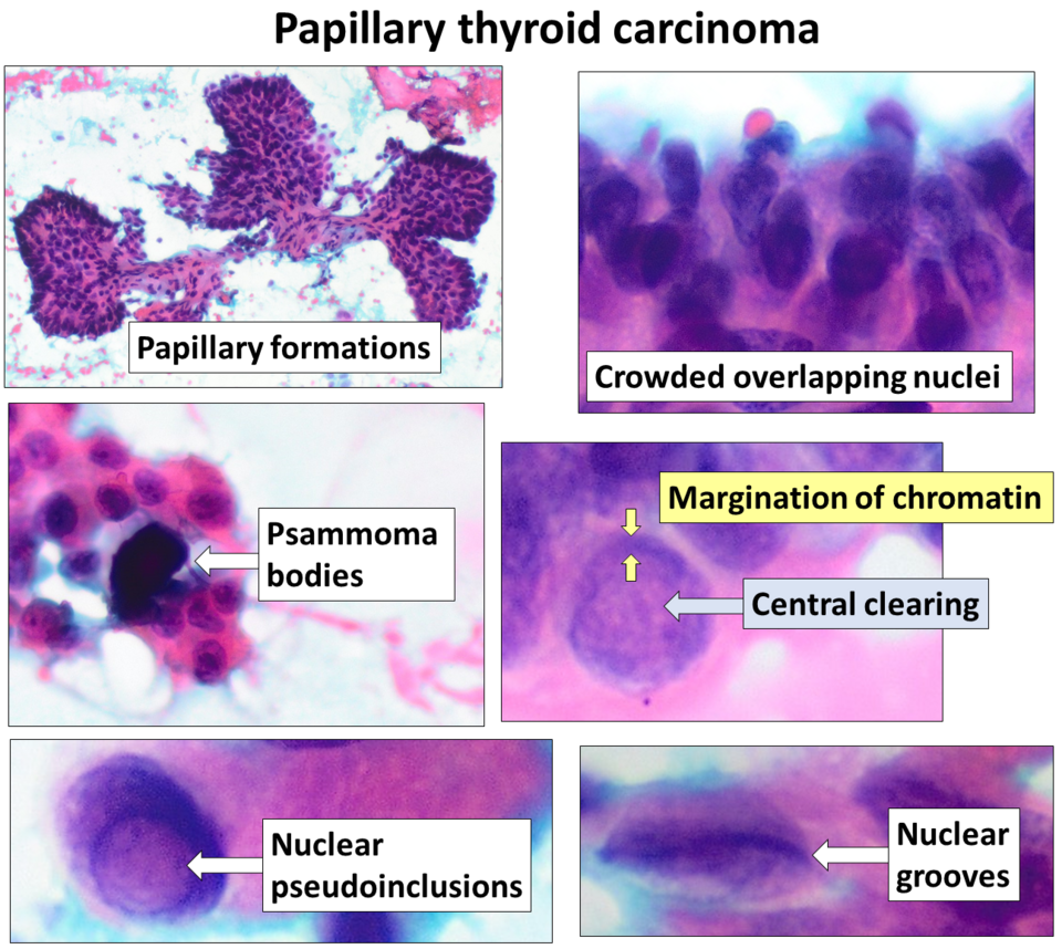Cytological features of Papillary carcinoma of thyroid 