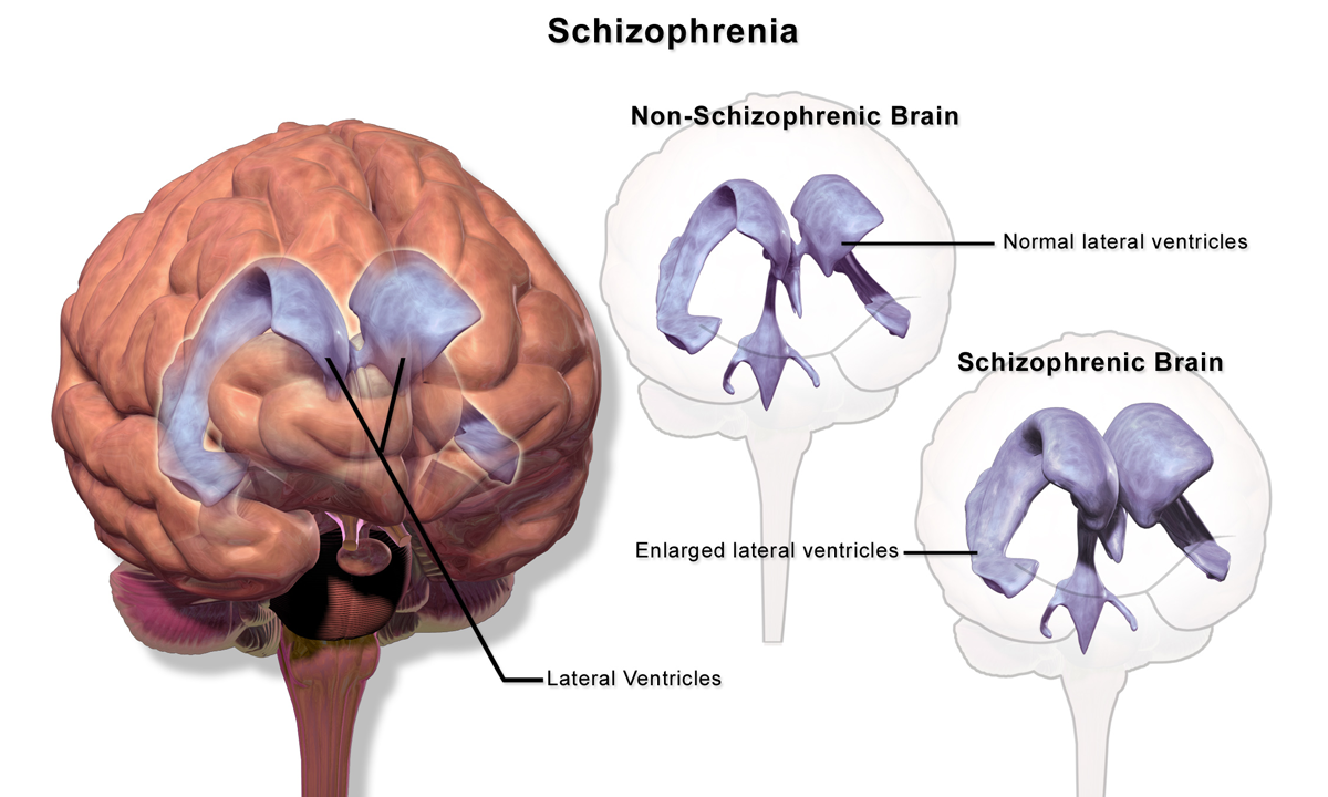 Schizophrenia
