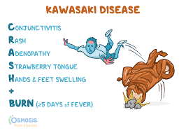 kawasaki disease