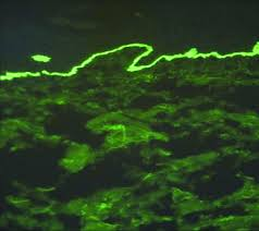 Direct immunofluorescence study showing linear immunoglobulin G and C3