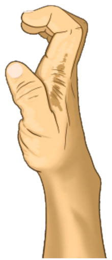 Upper Limb Nerve Deformities & Fracture Correlations
