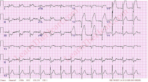 The Crashing Chest Pain