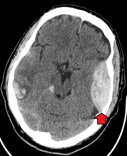 Extradural Hematoma
