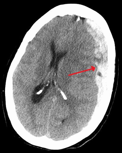Subdural Hematoma (SDH)