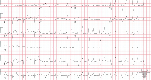 Acute Hyperkalemia