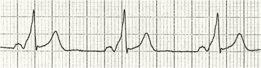 WPW Syndrome