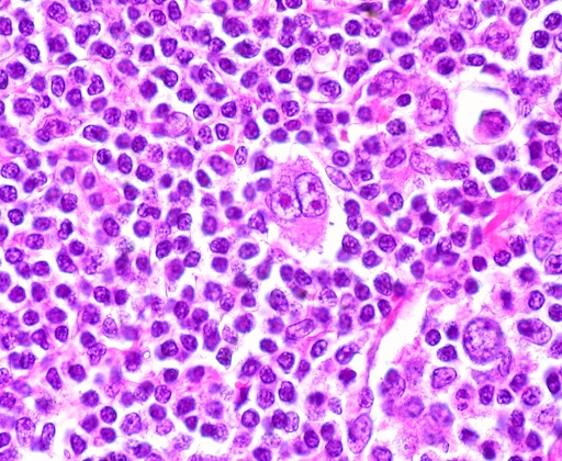 Hodgkin Lymphoma
