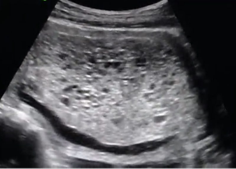 Molar Pregnancy