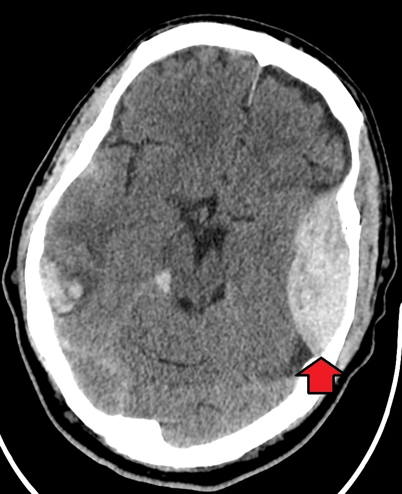 Extradural Hematoma