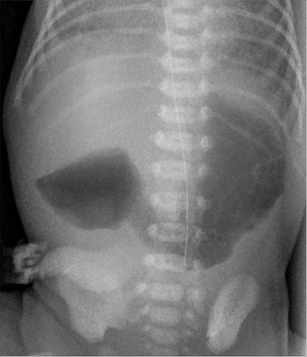 Duodenal Atresia