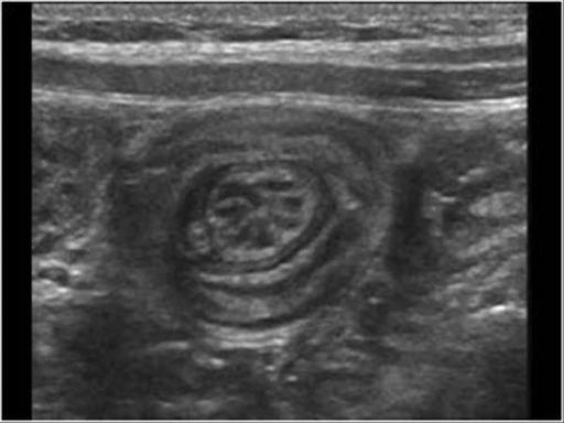 Intussusception