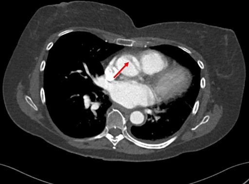 Image of Aortic Dissection
