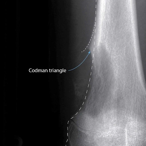Osteosarcoma
