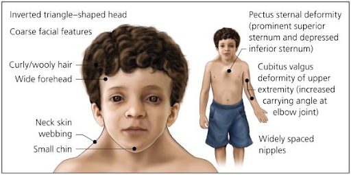 Noonan Syndrome